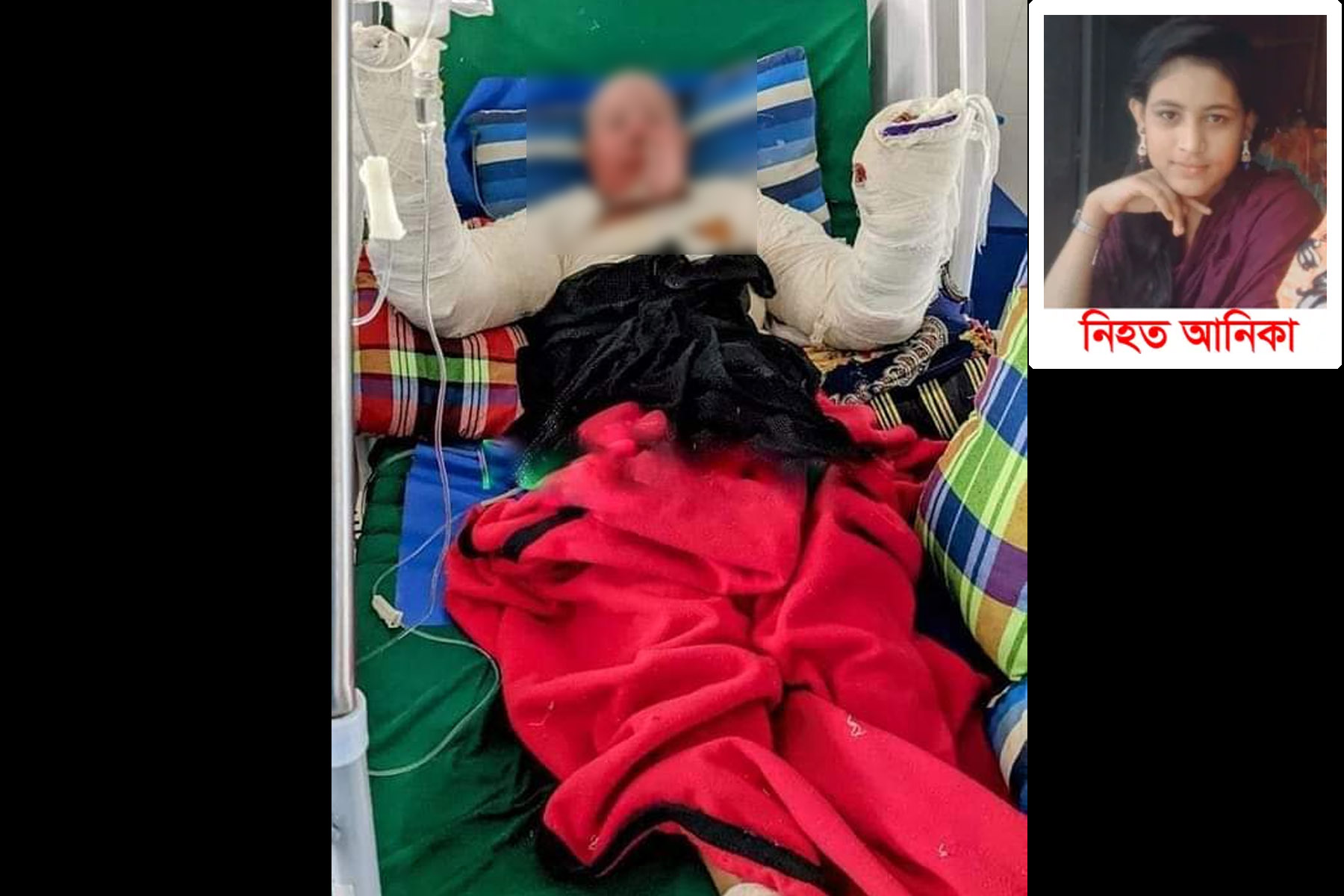 লক্ষ্মীপুরে আগুনে পুড়ে মারা যাওয়া সেই আনিকার মা মারা গেছে